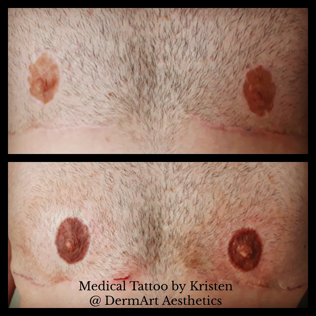 Areola/Nipple Tattoo | DermArt Aesthetics
