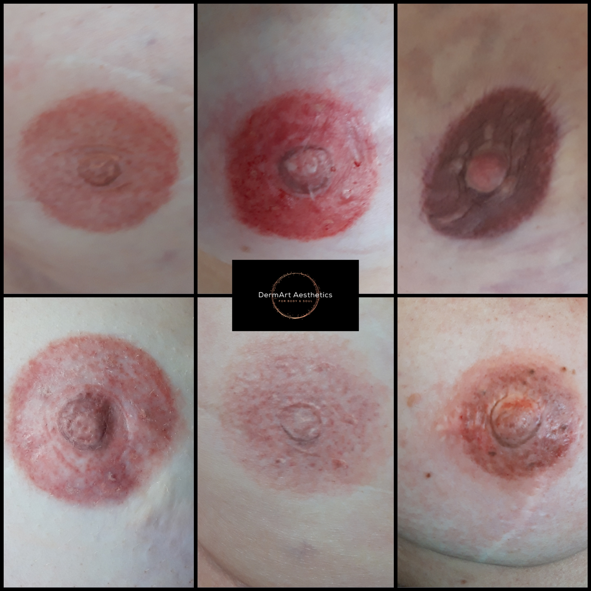 Areola/Nipple Tattoo | DermArt Aesthetics