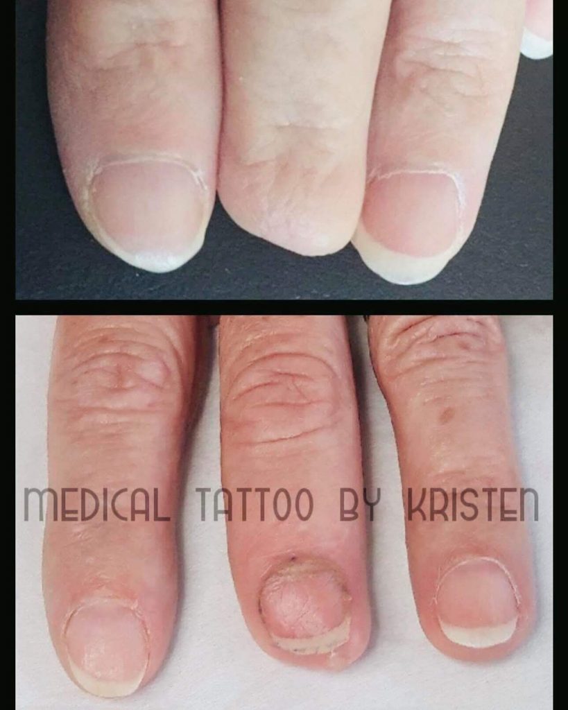 Missing Fingernail Toenail Tattoo Dermart Aesthetics