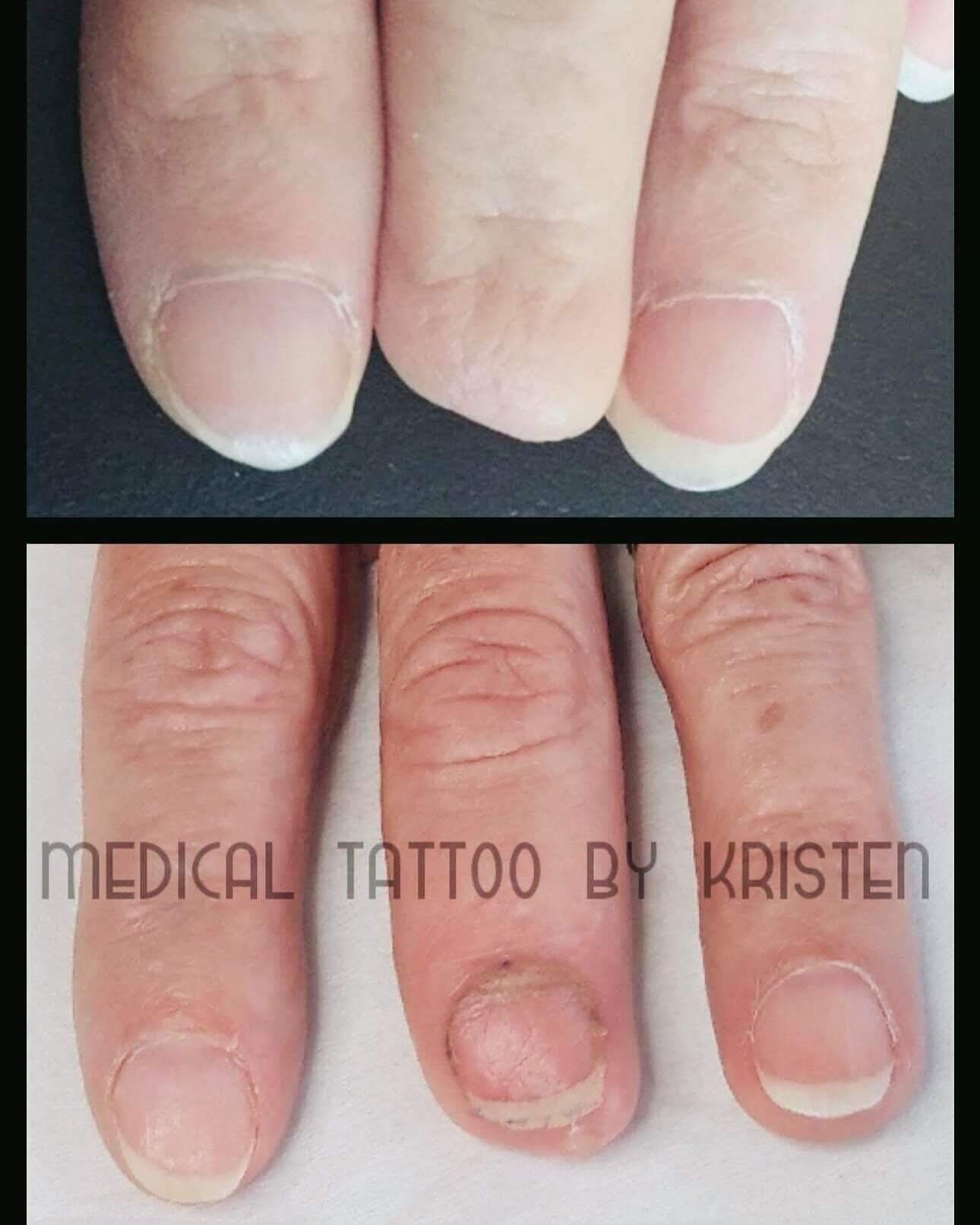 Missing Fingernail/Toenail Tattoo | DermArt Aesthetics