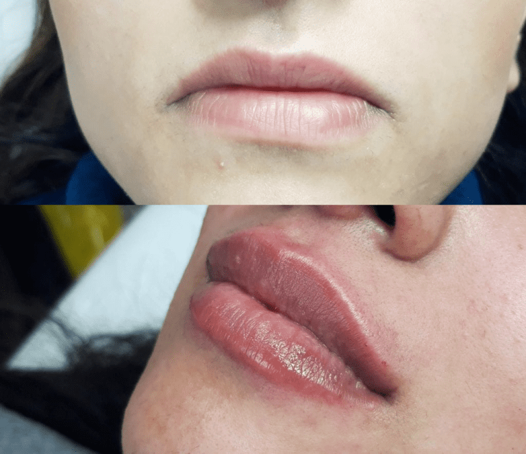 lip-filler-comparison