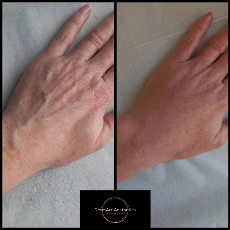 Profilo Hands. DermArt Aesthetics Baldoyle. Before and after.